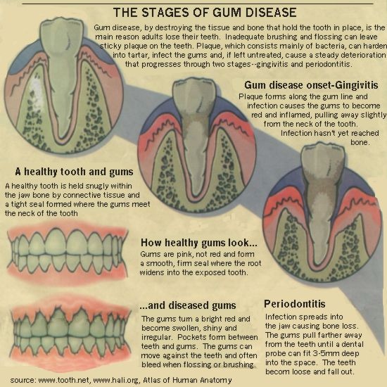 Teeth scaling Scaling and